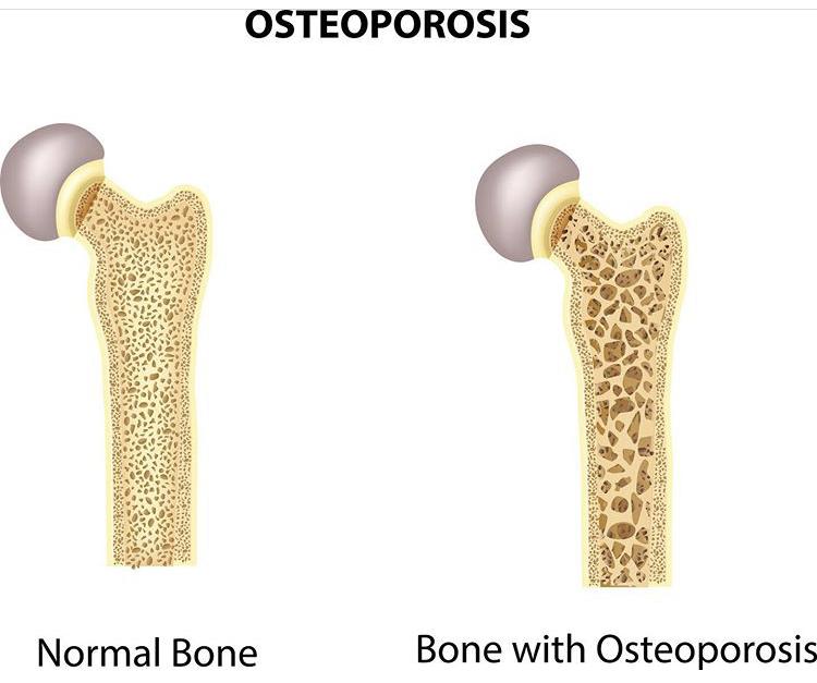 Mulheres x osteoporose